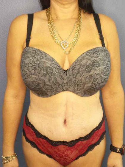 Abdominoplasty Before & After Patient #3426