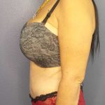 Abdominoplasty Before & After Patient #3426
