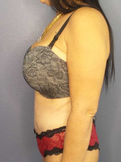 Abdominoplasty Before & After Patient #3426
