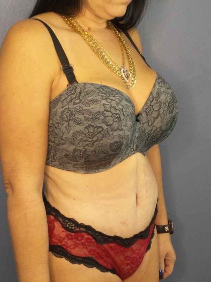 Abdominoplasty Before & After Patient #3426