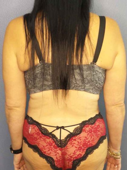 Abdominoplasty Before & After Patient #3426
