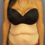 Abdominoplasty Before & After Patient #3426