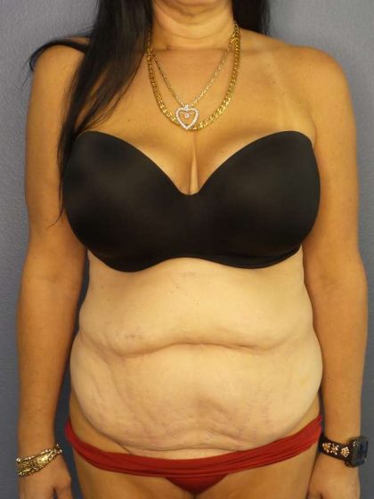 Abdominoplasty Before & After Patient #3426