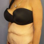 Abdominoplasty Before & After Patient #3426