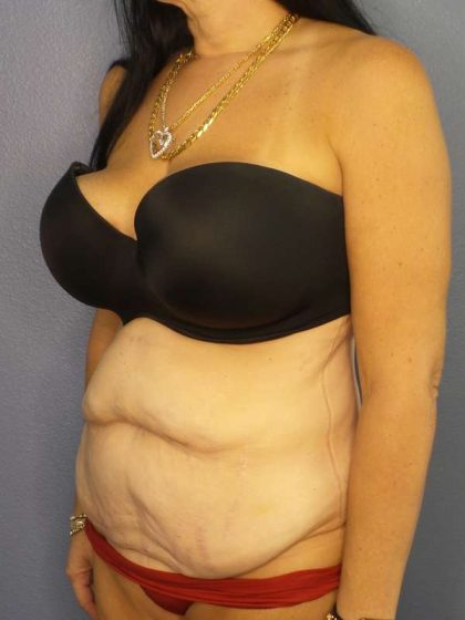 Abdominoplasty Before & After Patient #3426