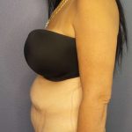 Abdominoplasty Before & After Patient #3426