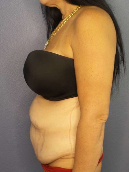 Abdominoplasty Before & After Patient #3426