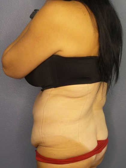 Abdominoplasty Before & After Patient #3426