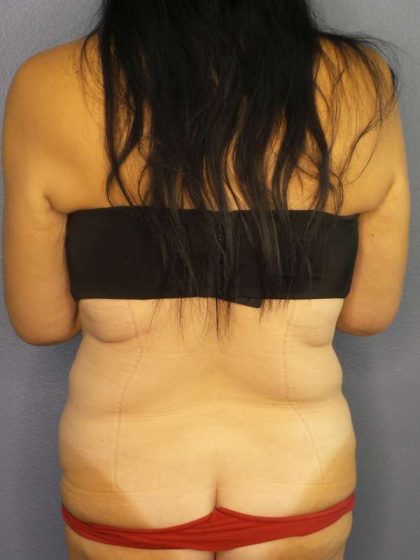 Abdominoplasty Before & After Patient #3426
