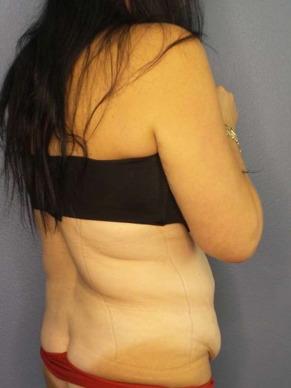 Abdominoplasty Before & After Patient #3426