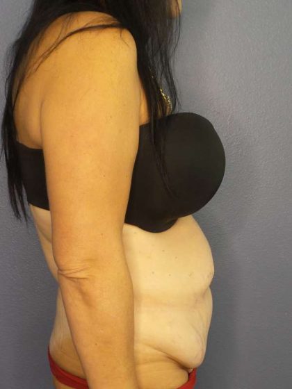 Abdominoplasty Before & After Patient #3426