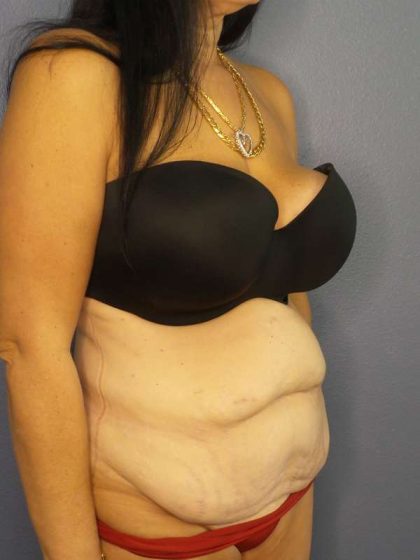 Abdominoplasty Before & After Patient #3426