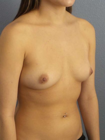 Breast Augmentation Before & After Patient #5529