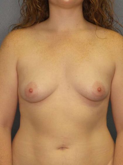 Breast Augmentation Before & After Patient #6519