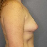 Breast Augmentation Before & After Patient #6519
