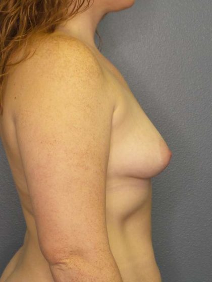 Breast Augmentation Before & After Patient #6519