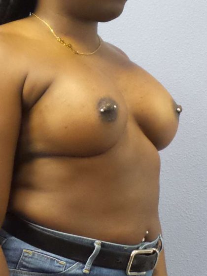 Breast Augmentation Before & After Patient #6813