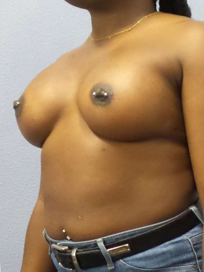 Breast Augmentation Before & After Patient #6813