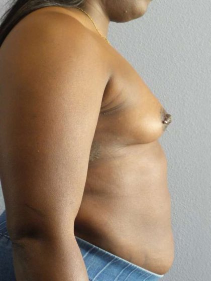 Breast Augmentation Before & After Patient #6813