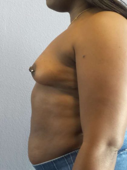 Breast Augmentation Before & After Patient #6813