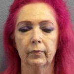 Resurfacing Before & After Patient #8867