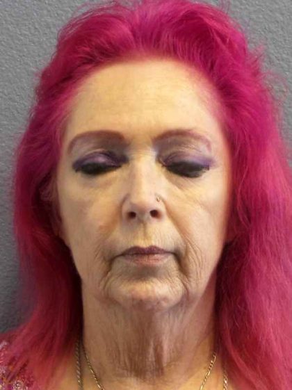 Resurfacing Before & After Patient #8867