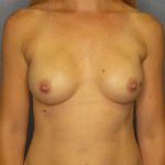 Breast Augmentation Before & After Patient #6293
