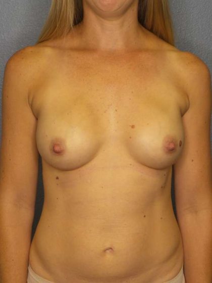 Breast Augmentation Before & After Patient #6293