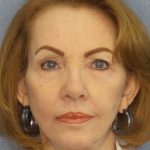 Facelift Before & After Patient #7569