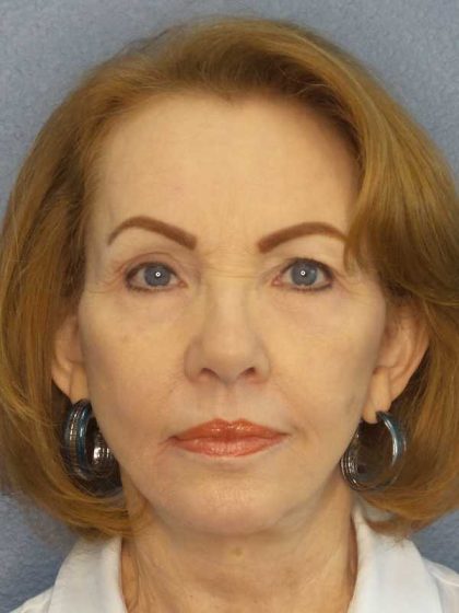 Facelift Before & After Patient #7569