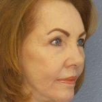 Facelift Before & After Patient #7569