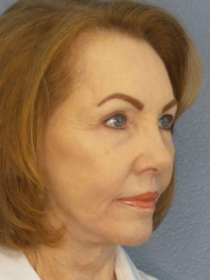 Facelift Before & After Patient #7569