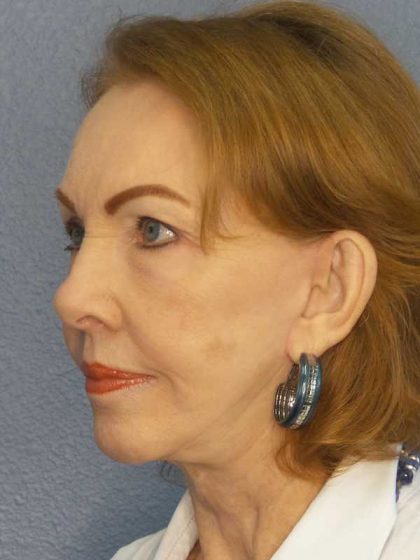 Facelift Before & After Patient #7569