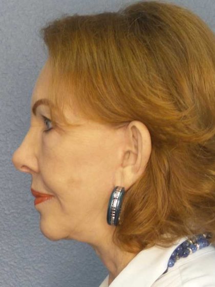 Facelift Before & After Patient #7569