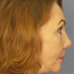 Facelift Before & After Patient #7569
