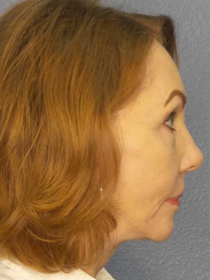 Facelift Before & After Patient #7569