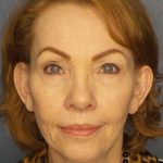 Facelift Before & After Patient #7569