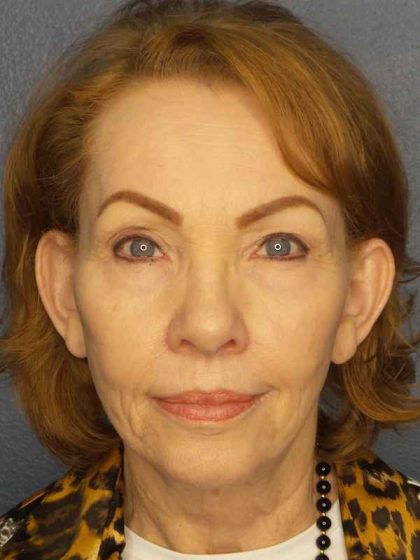 Facelift Before & After Patient #7569