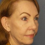 Facelift Before & After Patient #7569