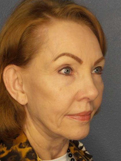 Facelift Before & After Patient #7569