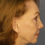 Facelift Before & After Patient #7569