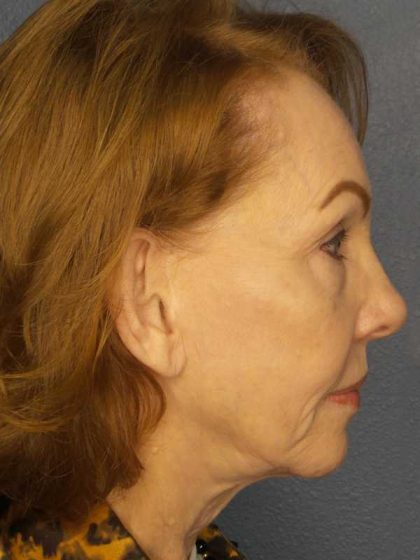 Facelift Before & After Patient #7569
