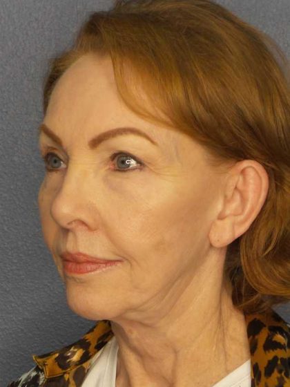 Facelift Before & After Patient #7569