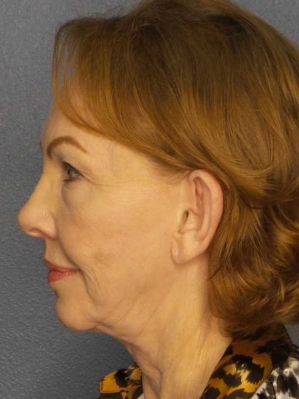 Facelift Before & After Patient #7569