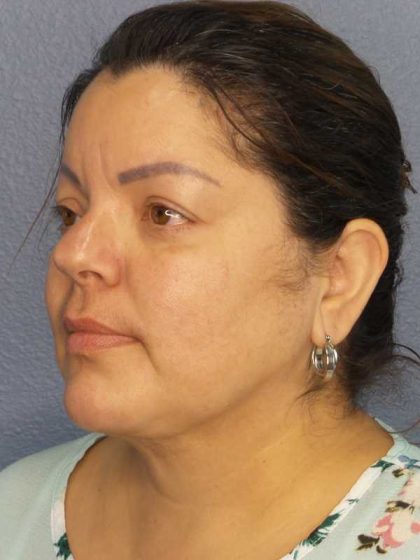 Liposuction of the Neck Before & After Patient #12093