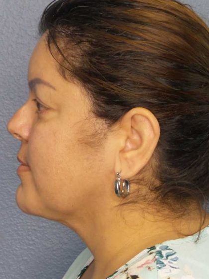 Liposuction of the Neck Before & After Patient #12093