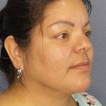 Liposuction of the Neck Before & After Patient #12093