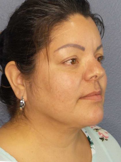 Liposuction of the Neck Before & After Patient #12093