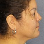 Liposuction of the Neck Before & After Patient #12093