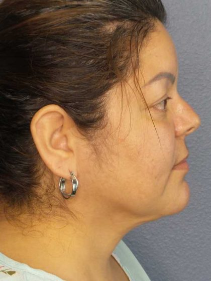 Liposuction of the Neck Before & After Patient #12093